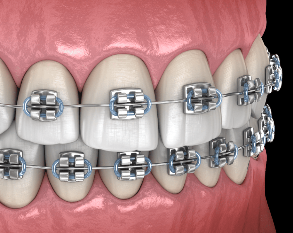 лігатурні брекети